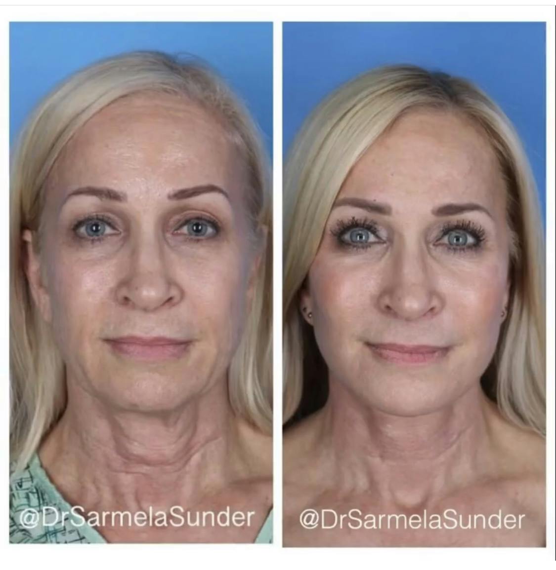 Facelift Before & After Gallery - Patient 107983 - Image 1