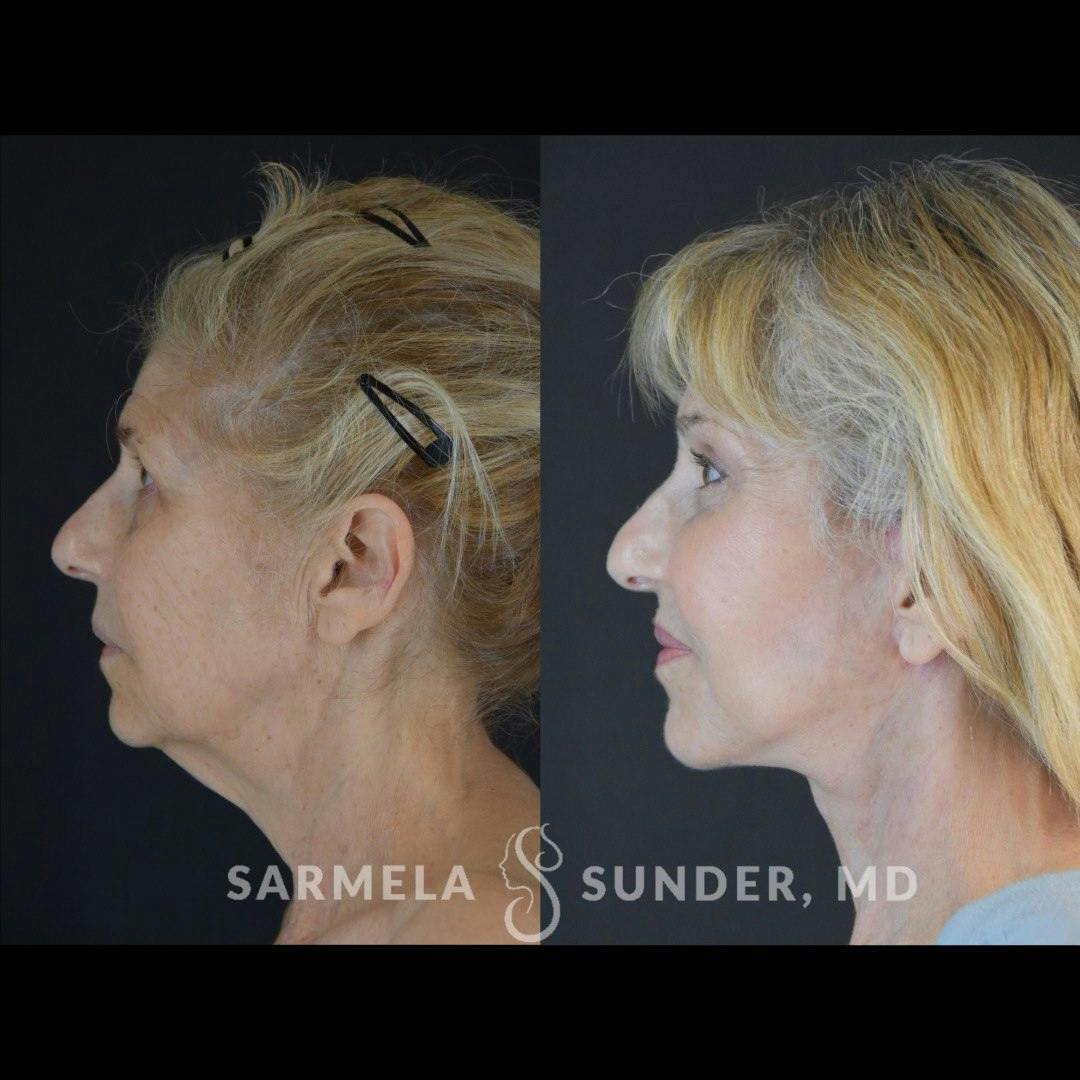 Facelift Before & After Gallery - Patient 432714 - Image 3