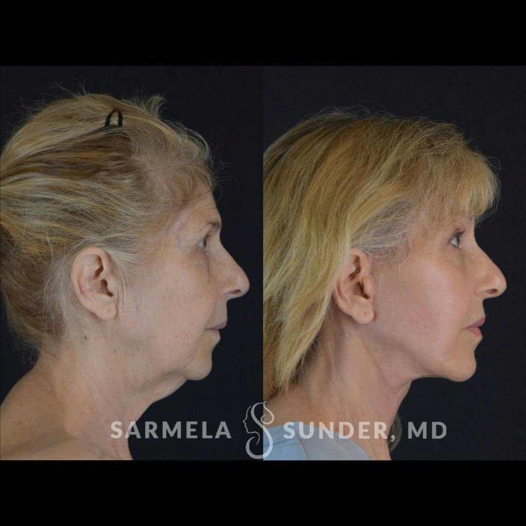 Facelift Before & After Gallery - Patient 432714 - Image 2