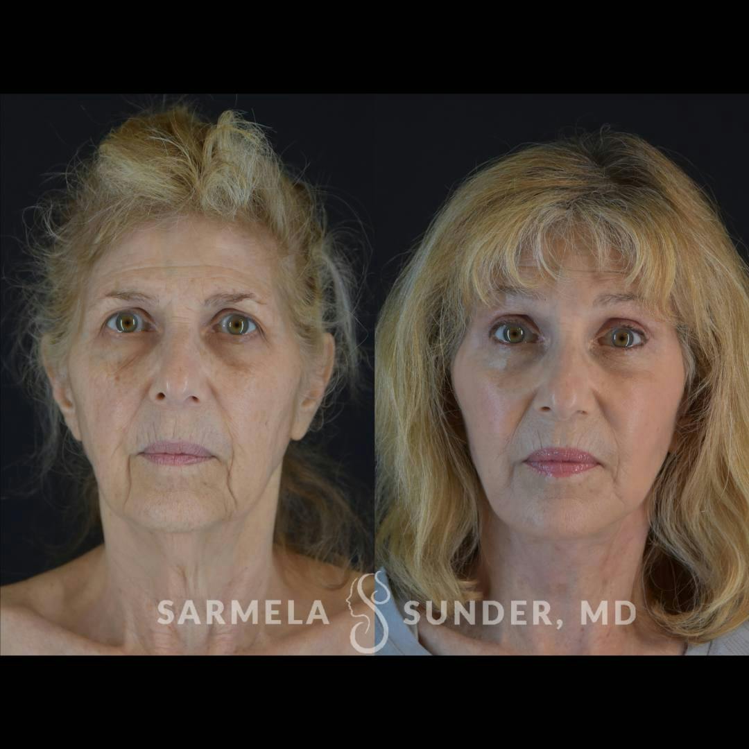 Facelift Before & After Gallery - Patient 432714 - Image 1