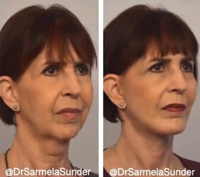 Facelift Before & After Gallery - Patient 329335 - Image 1