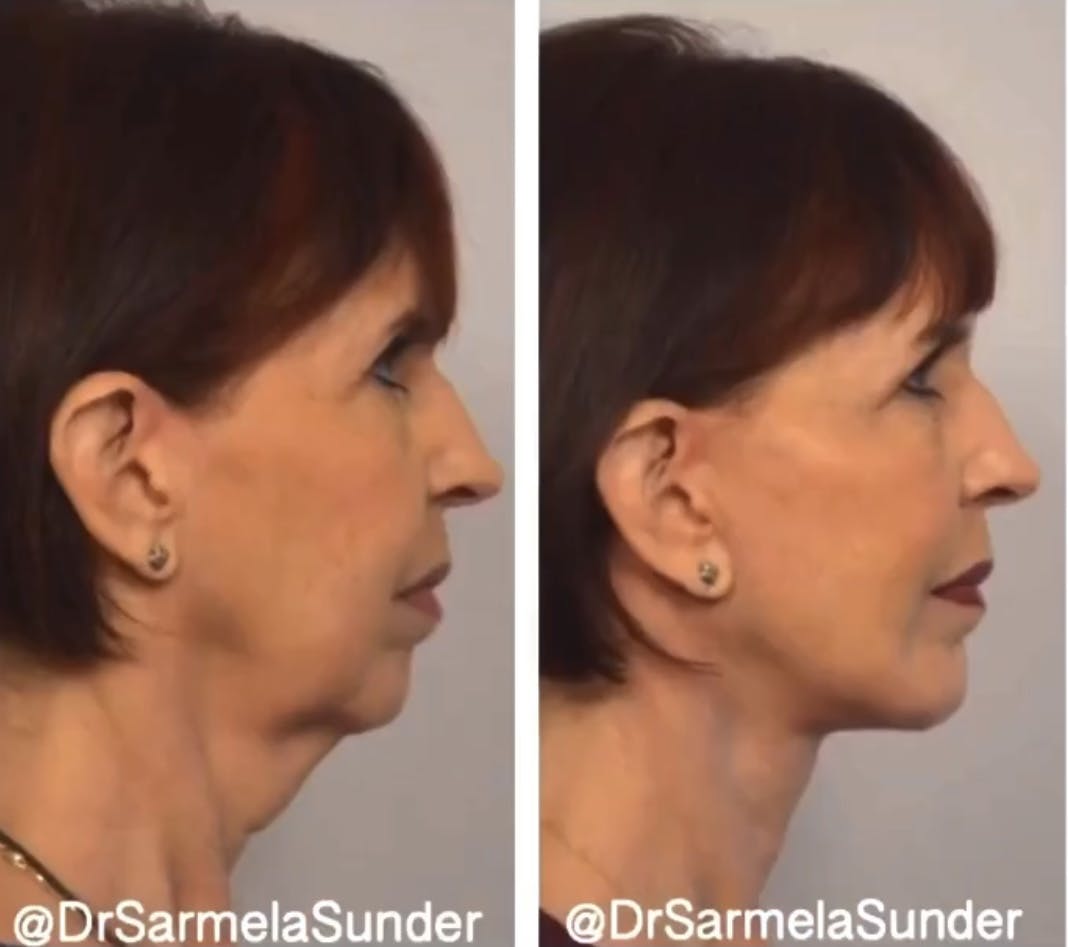 Facelift Before & After Gallery - Patient 329335 - Image 2