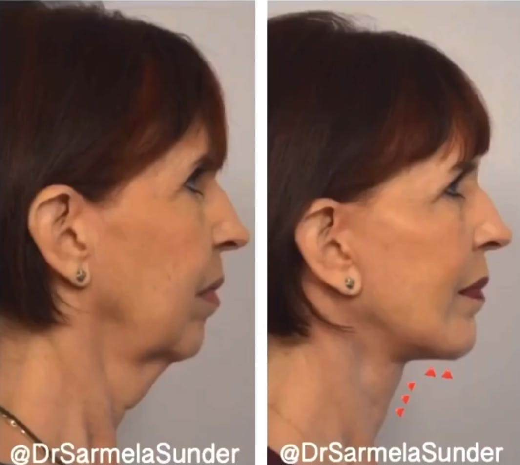 Facelift Before & After Gallery - Patient 329335 - Image 3