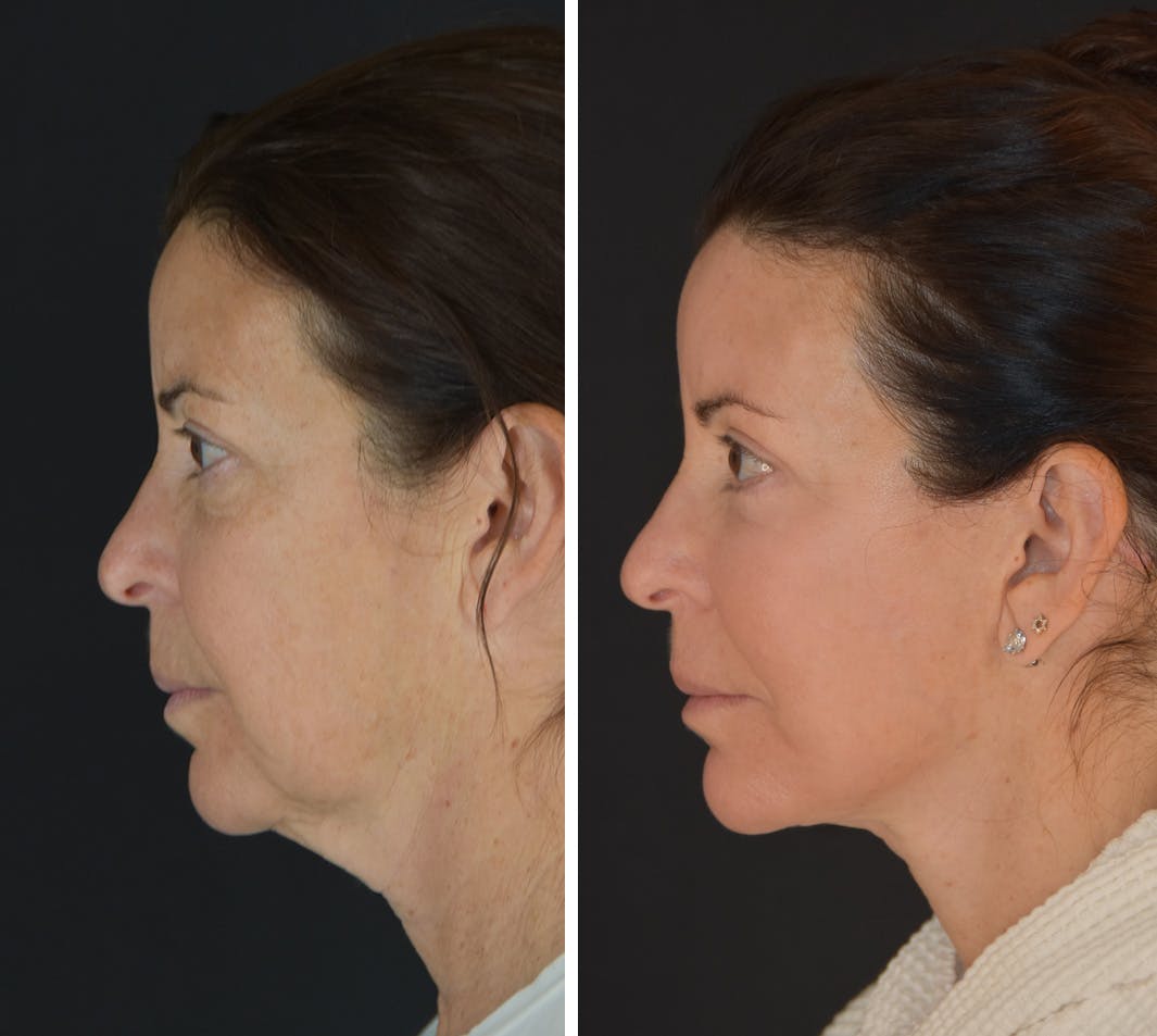 Facelift Before & After Gallery - Patient 905370 - Image 3