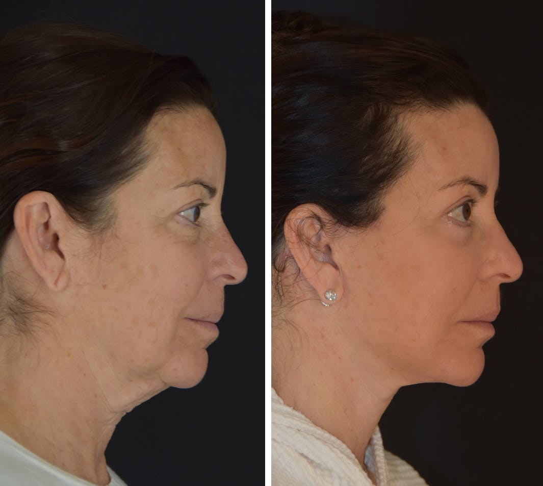 Facelift Before & After Gallery - Patient 905370 - Image 4