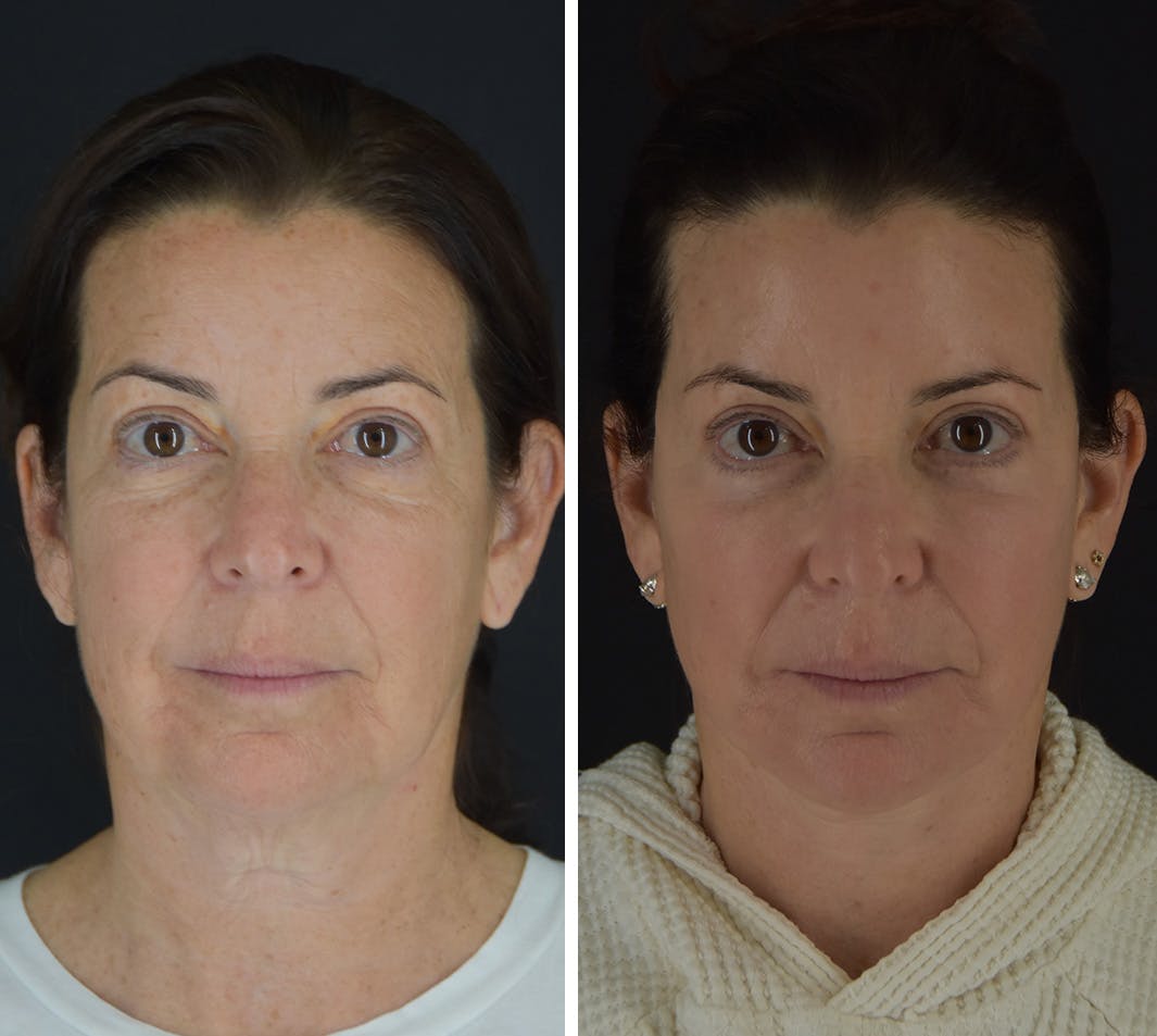 Facelift Before & After Gallery - Patient 905370 - Image 1