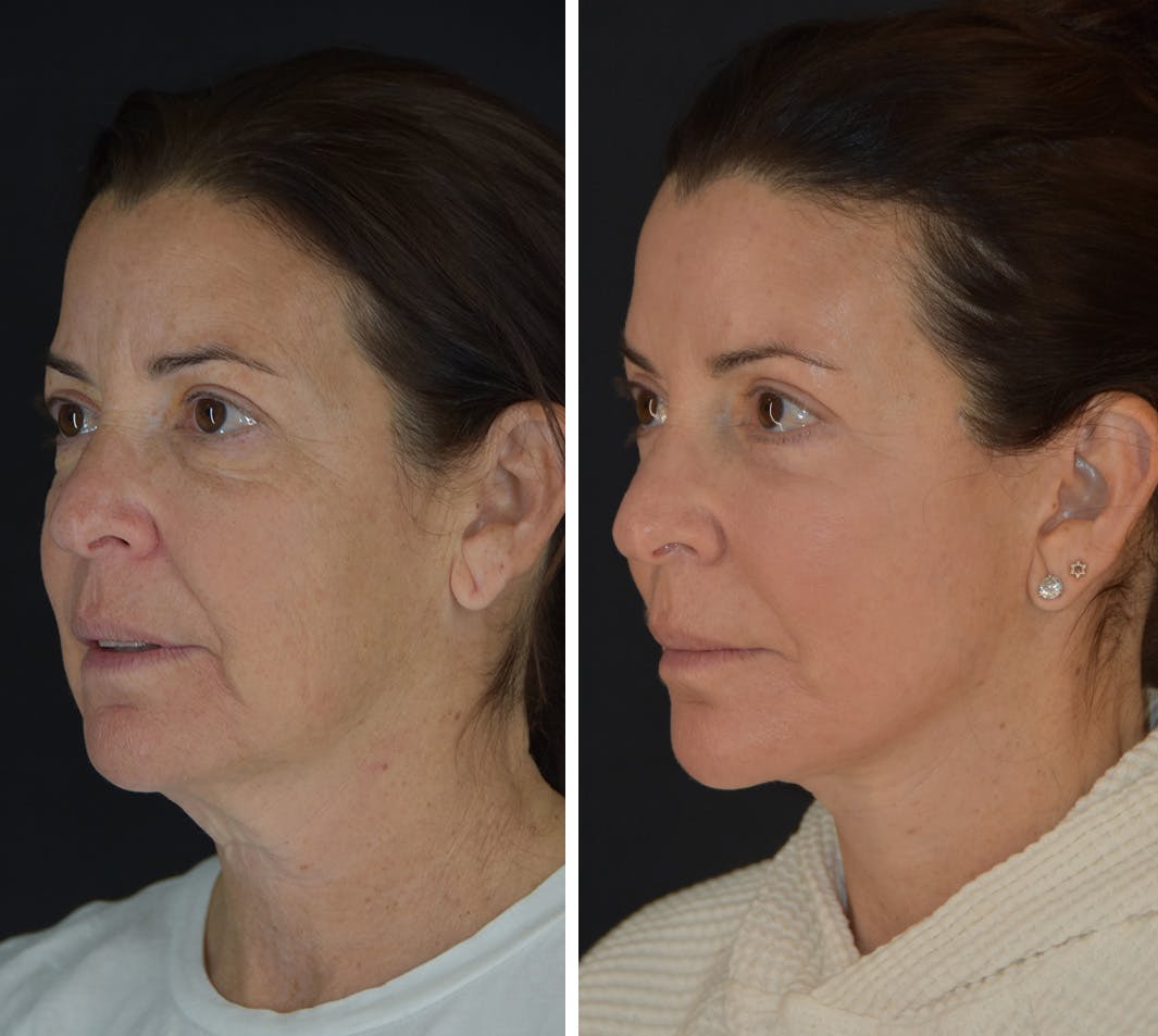 Facelift Before & After Gallery - Patient 905370 - Image 2