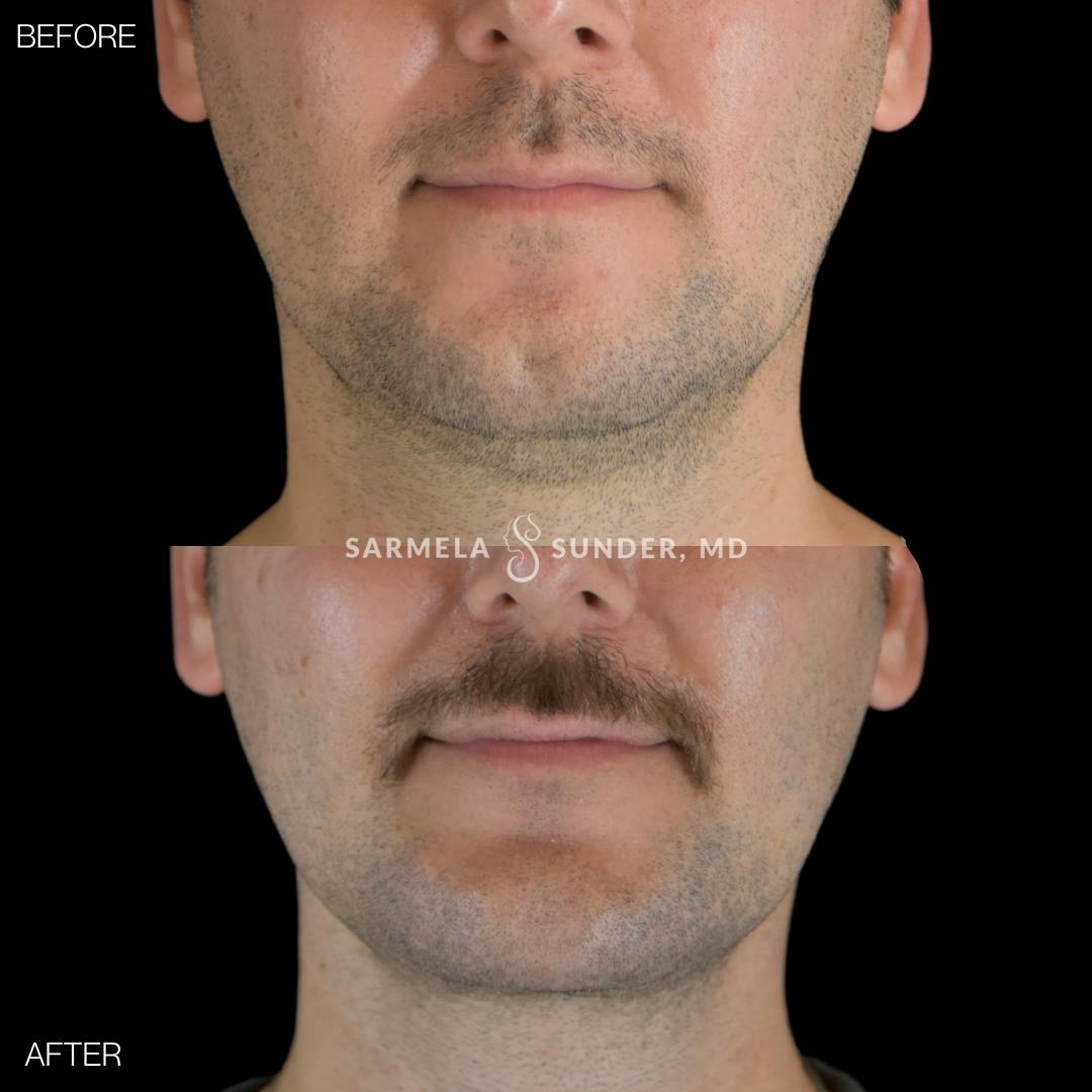 Facetite Before & After Gallery - Patient 358342 - Image 1