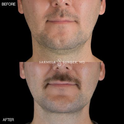 Facetite Before & After Gallery - Patient 358342 - Image 1