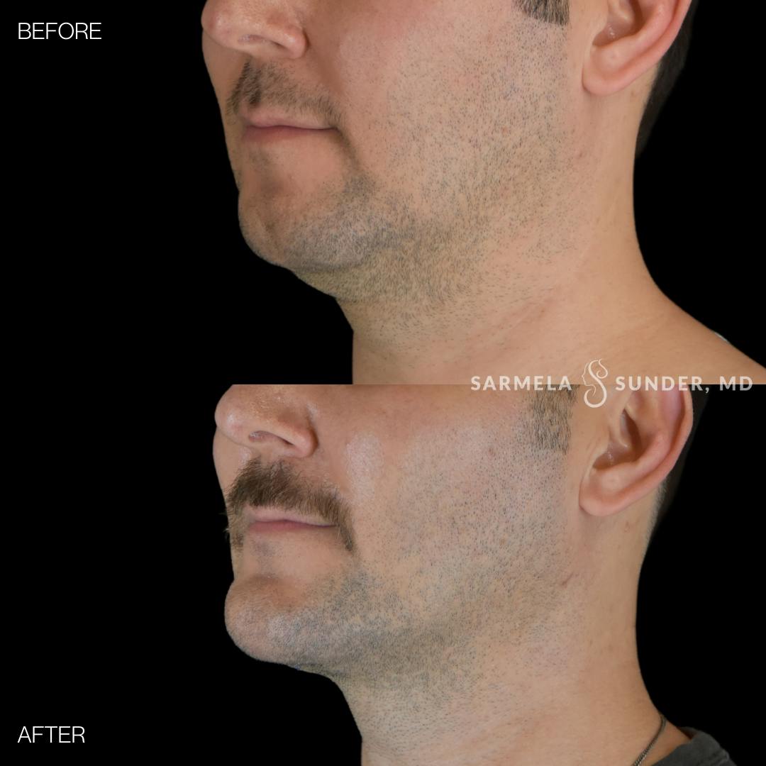 Facetite Before & After Gallery - Patient 358342 - Image 4