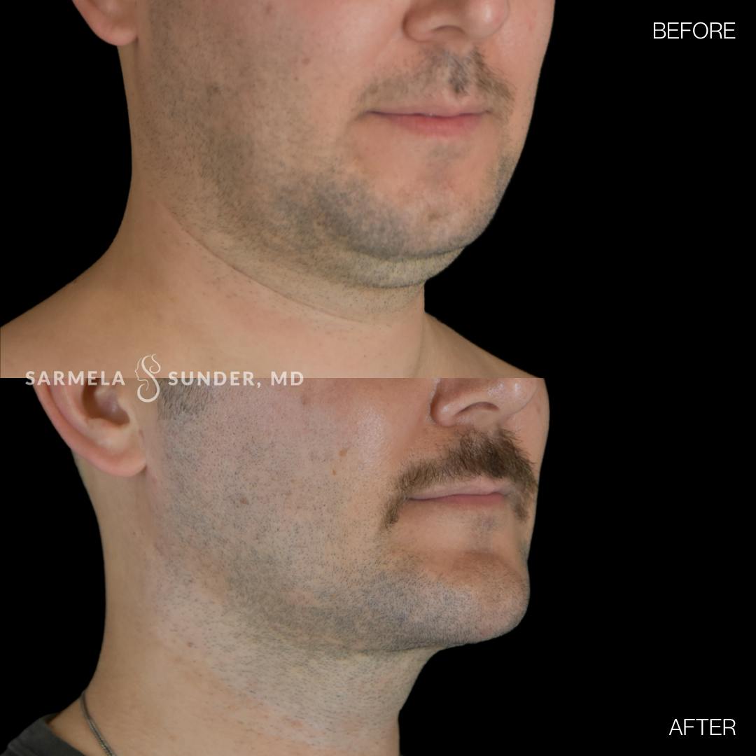 Facetite Before & After Gallery - Patient 358342 - Image 2