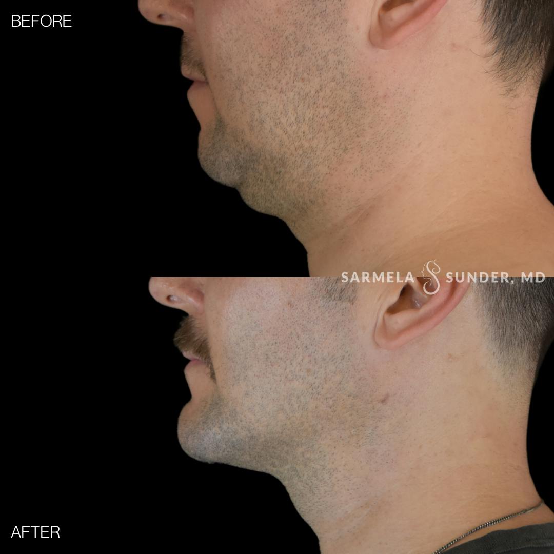 Facetite Before & After Gallery - Patient 358342 - Image 5
