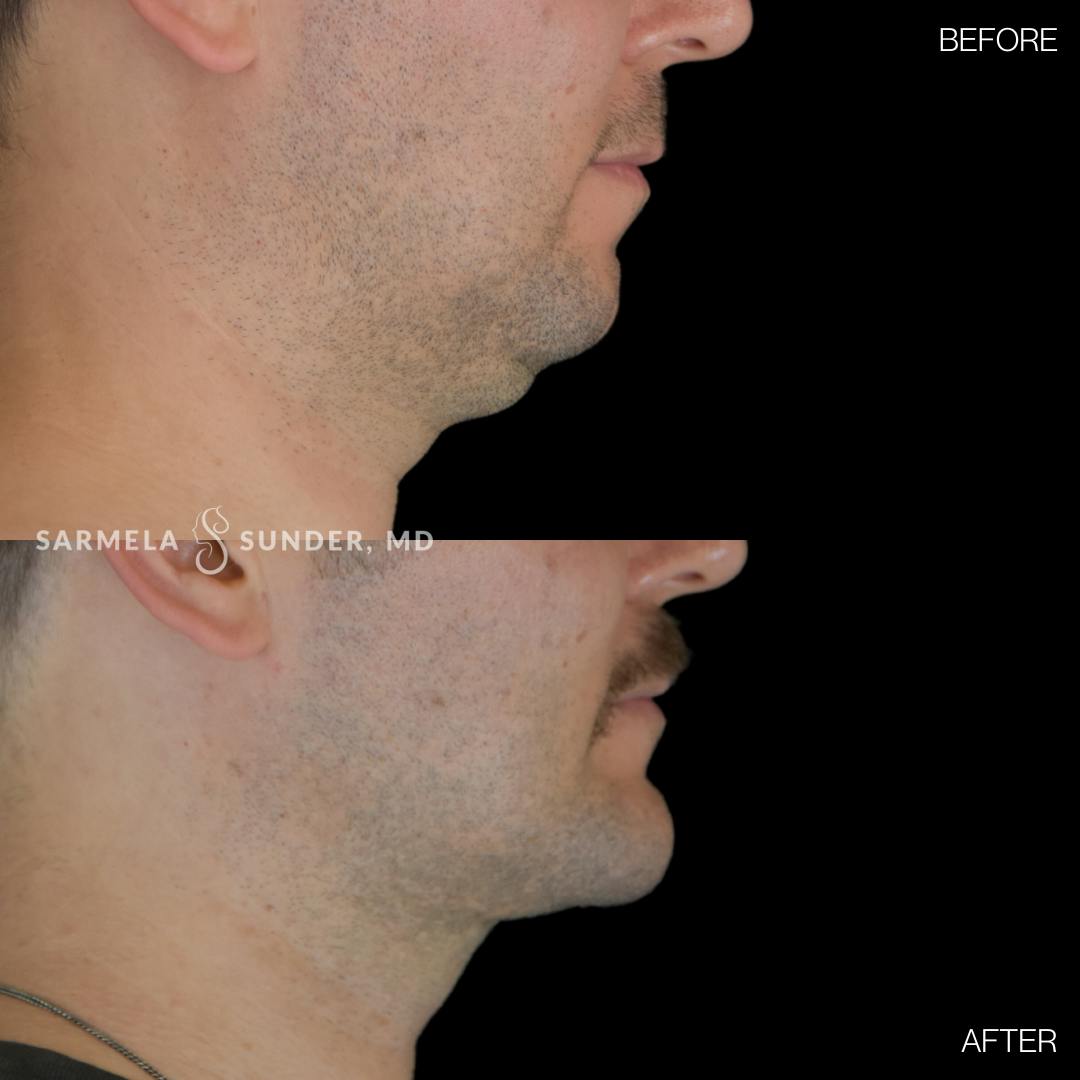 Facetite Before & After Gallery - Patient 358342 - Image 3