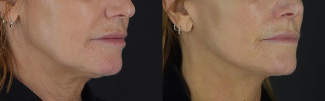 Facelift Before & After Gallery - Patient 472786 - Image 2