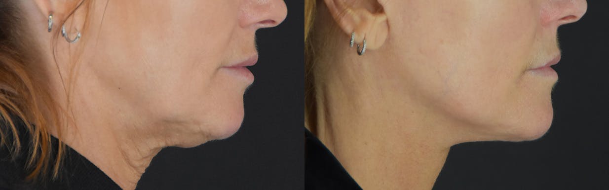 Facelift Before & After Gallery - Patient 472786 - Image 3
