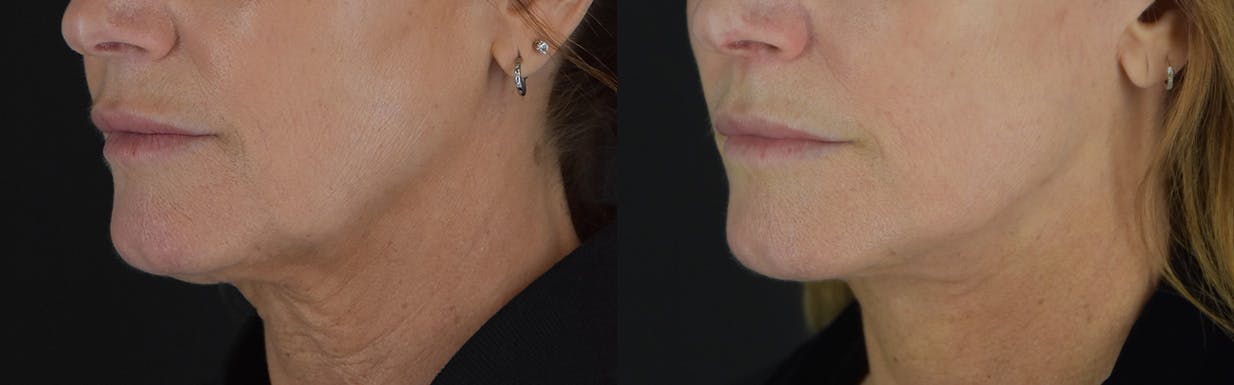 Facelift Before & After Gallery - Patient 472786 - Image 4