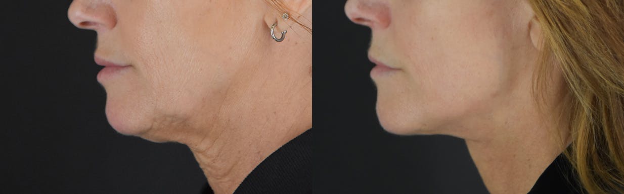 Facelift Before & After Gallery - Patient 472786 - Image 5