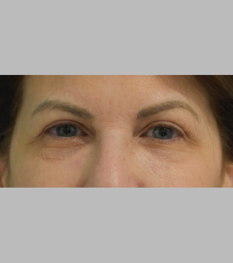 Upper Blepharoplasty Before & After Gallery - Patient 425982 - Image 1