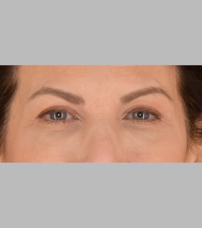 Upper Blepharoplasty Before & After Gallery - Patient 425982 - Image 2