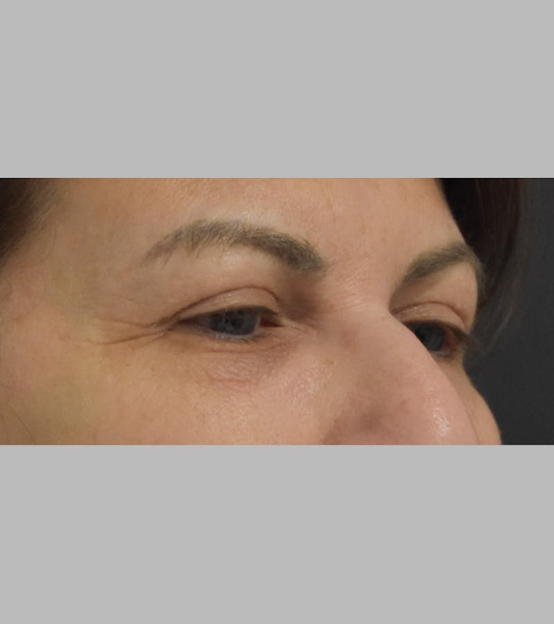 Upper Blepharoplasty Before & After Gallery - Patient 425982 - Image 3
