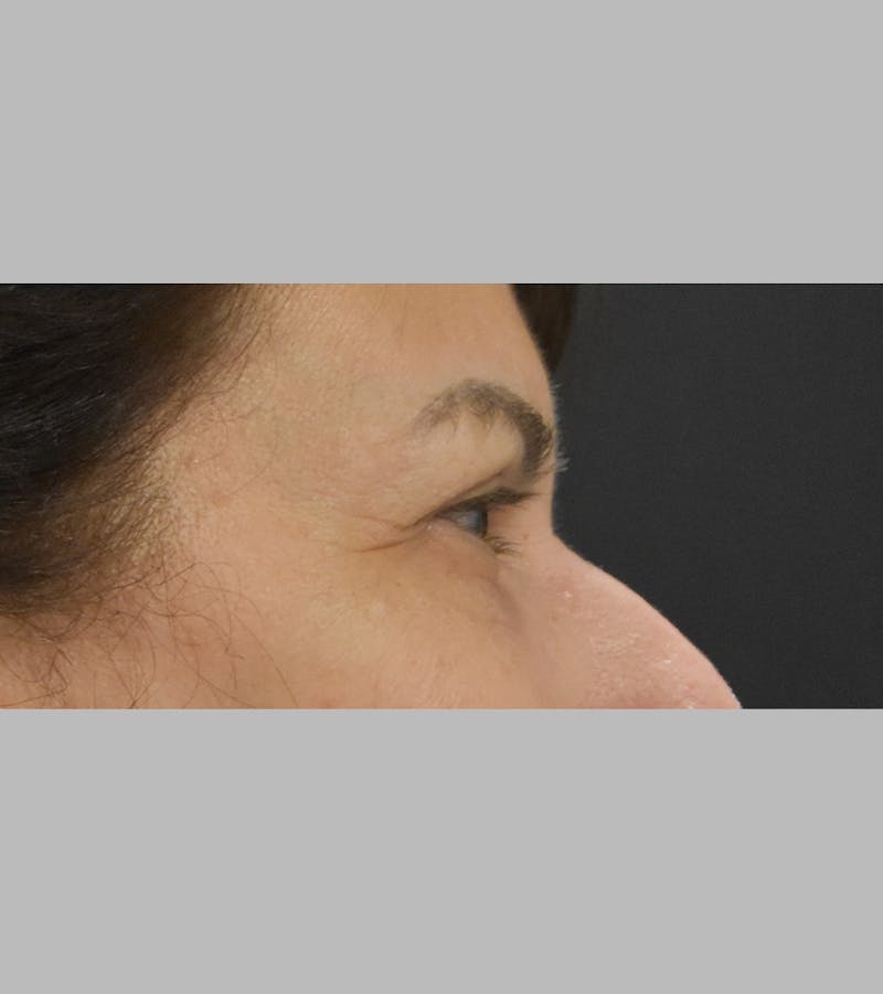 Upper Blepharoplasty Before & After Gallery - Patient 425982 - Image 5