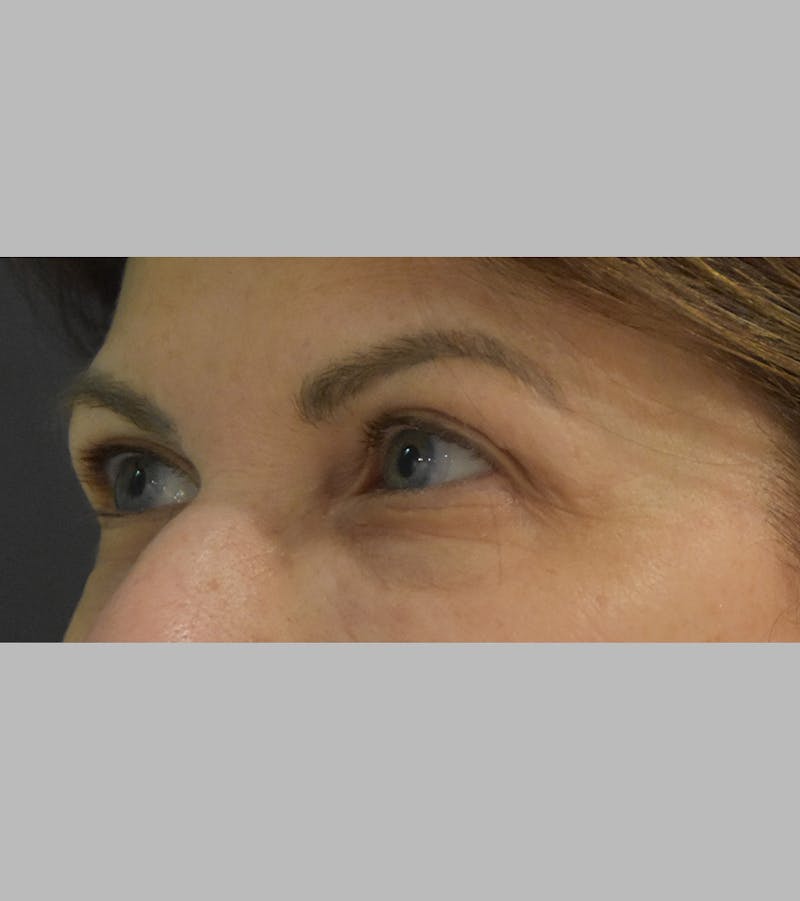 Upper Blepharoplasty Before & After Gallery - Patient 425982 - Image 7