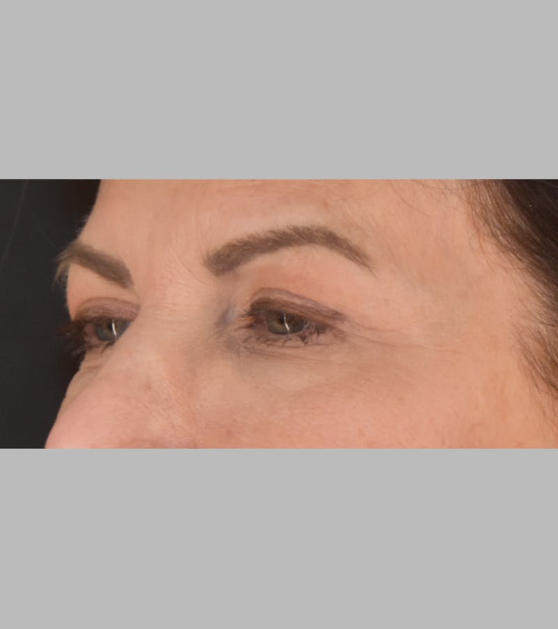 Upper Blepharoplasty Before & After Gallery - Patient 425982 - Image 8