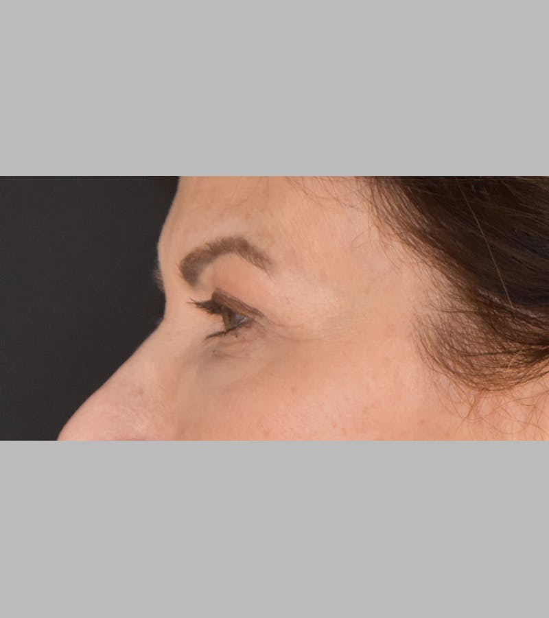 Upper Blepharoplasty Before & After Gallery - Patient 425982 - Image 10