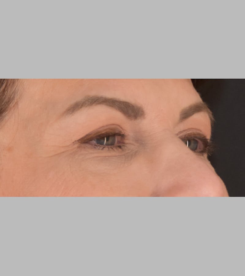 Upper Blepharoplasty Before & After Gallery - Patient 425982 - Image 4