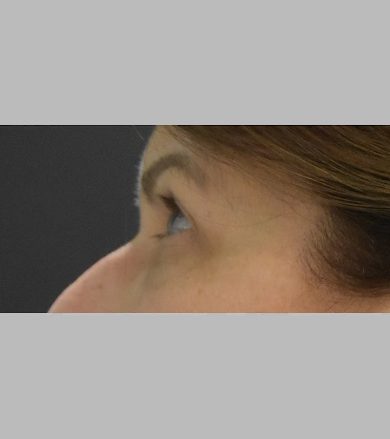 Upper Blepharoplasty Before & After Gallery - Patient 425982 - Image 9
