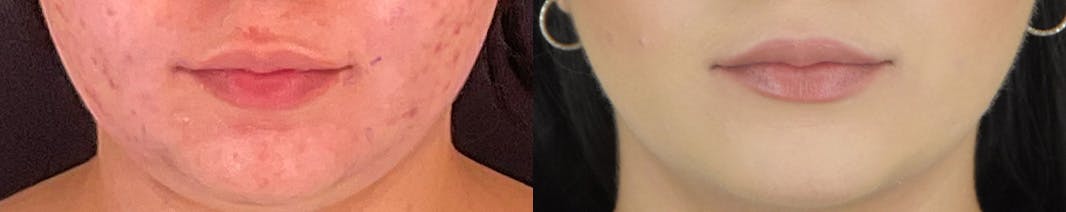 Facetite Before & After Gallery - Patient 236552 - Image 1