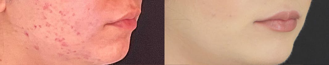 Facetite Before & After Gallery - Patient 236552 - Image 2
