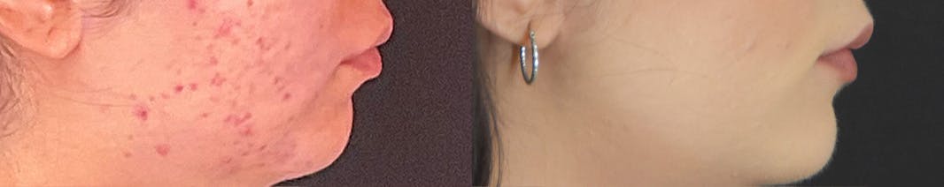Facetite Before & After Gallery - Patient 236552 - Image 3