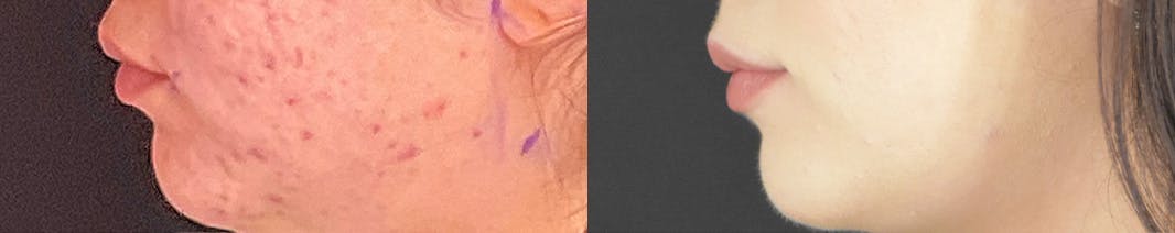 Facetite Before & After Gallery - Patient 236552 - Image 5