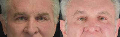 Brow Lift Before & After Gallery - Patient 362090 - Image 1
