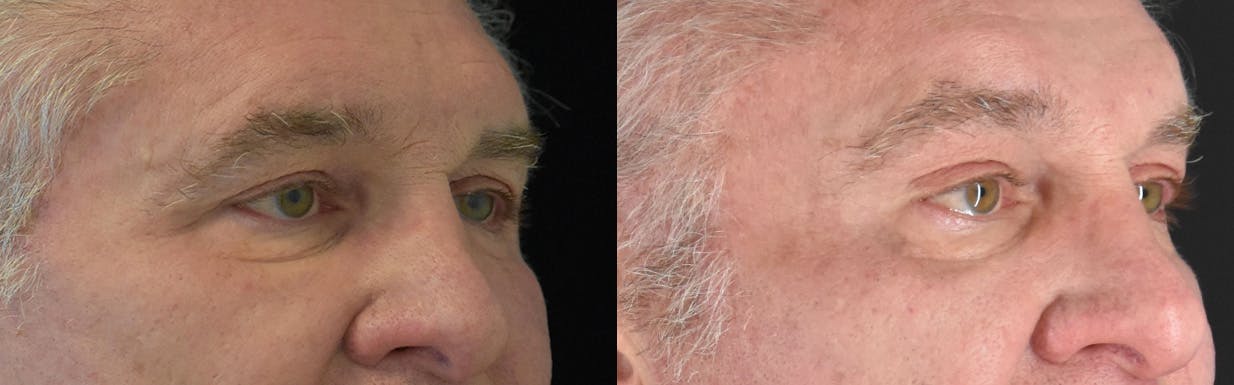 Brow Lift Before & After Gallery - Patient 362090 - Image 2