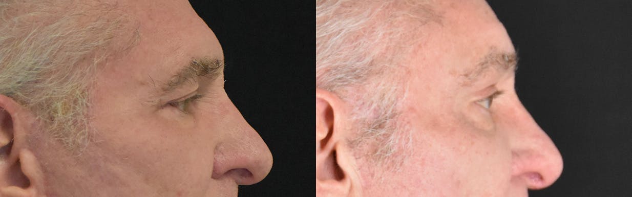 Brow Lift Before & After Gallery - Patient 362090 - Image 3