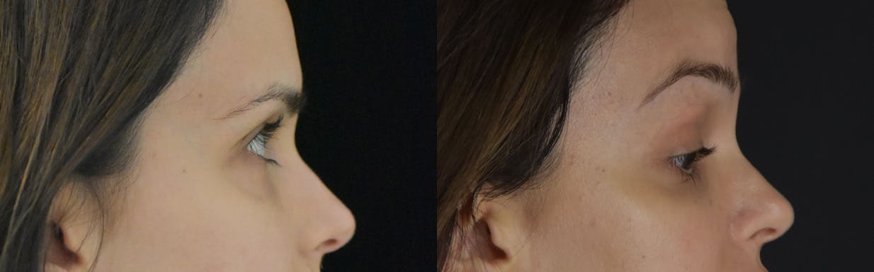 Brow Lift Before & After Gallery - Patient 105750 - Image 4