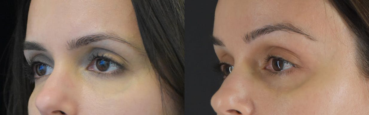 Brow Lift Before & After Gallery - Patient 105750 - Image 2