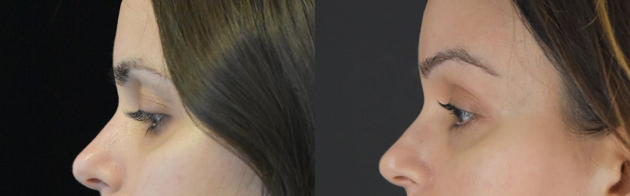 Brow Lift Before & After Gallery - Patient 105750 - Image 3