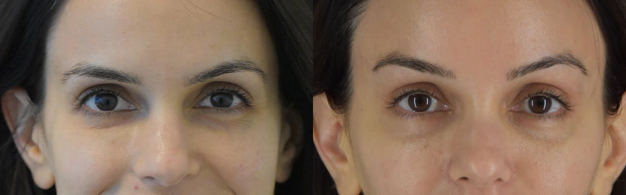 Brow Lift Before & After Gallery - Patient 105750 - Image 1