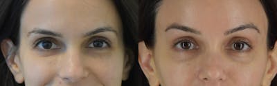 Brow Lift Before & After Gallery - Patient 105750 - Image 1