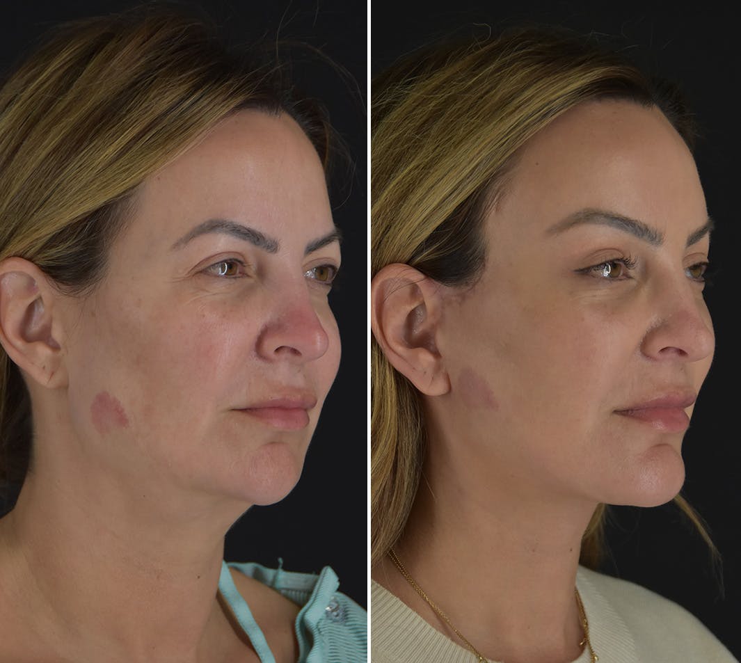 Neck Lift Before & After Gallery - Patient 275582 - Image 2