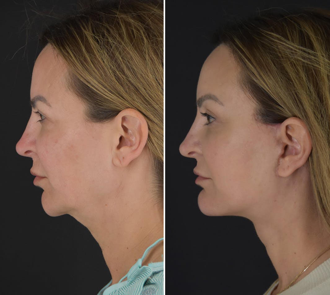 Neck Lift Before & After Gallery - Patient 275582 - Image 5