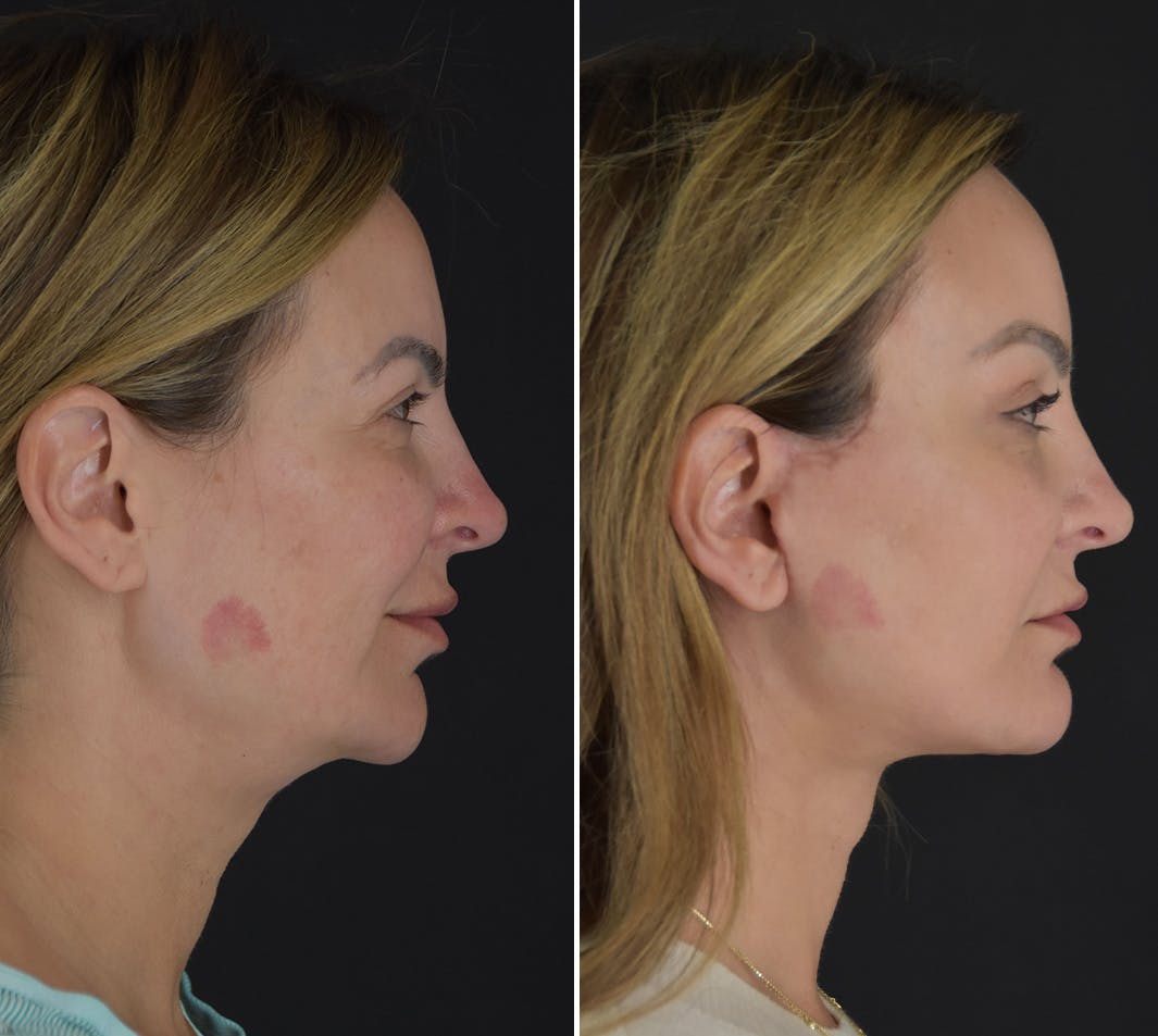 Neck Lift Before & After Gallery - Patient 275582 - Image 3