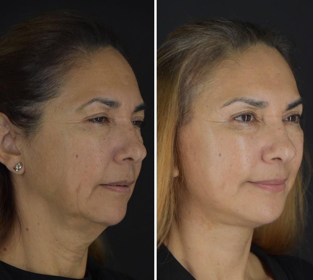 Facelift Before & After Gallery - Patient 249453 - Image 2