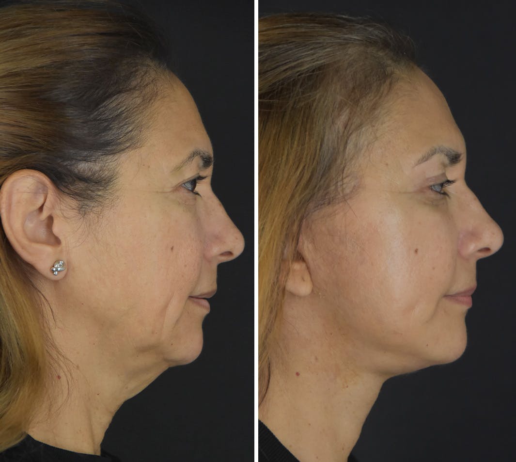 Facelift Before & After Gallery - Patient 249453 - Image 3