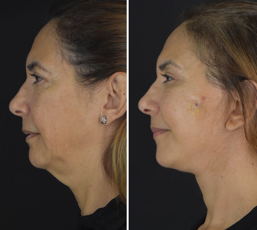 Facelift Before & After Gallery - Patient 249453 - Image 5