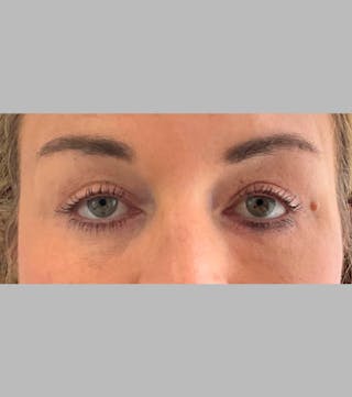 Upper Blepharoplasty Before & After Gallery - Patient 252669 - Image 2