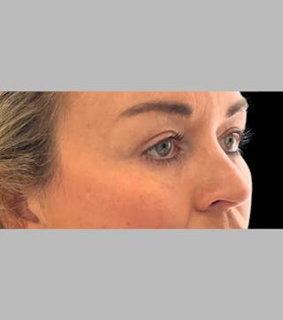 Upper Blepharoplasty Before & After Gallery - Patient 252669 - Image 4